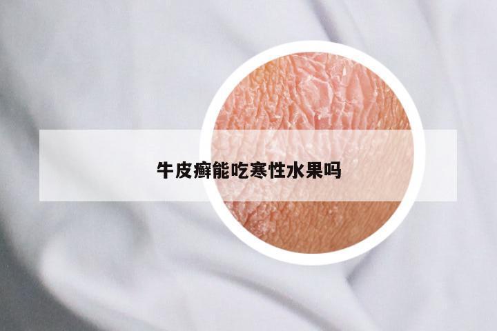 牛皮癣能吃寒性水果吗
