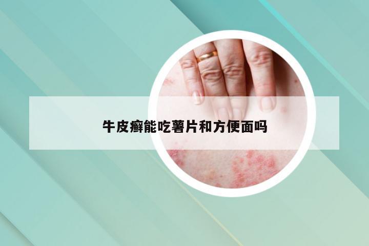 牛皮癣能吃薯片和方便面吗