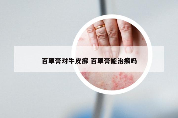 百草膏对牛皮癣 百草膏能治癣吗