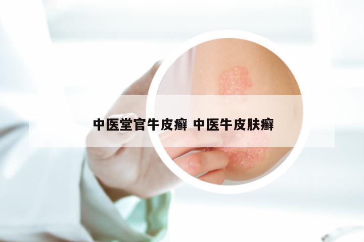 中医堂官牛皮癣 中医牛皮肤癣