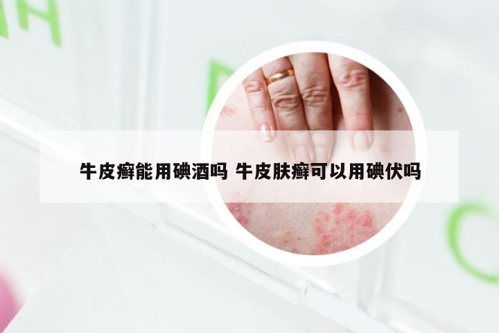 牛皮癣能用碘酒吗 牛皮肤癣可以用碘伏吗