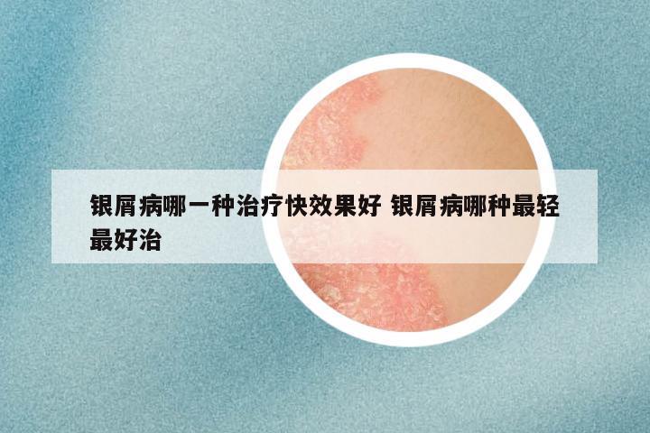 银屑病哪一种治疗快效果好 银屑病哪种最轻最好治