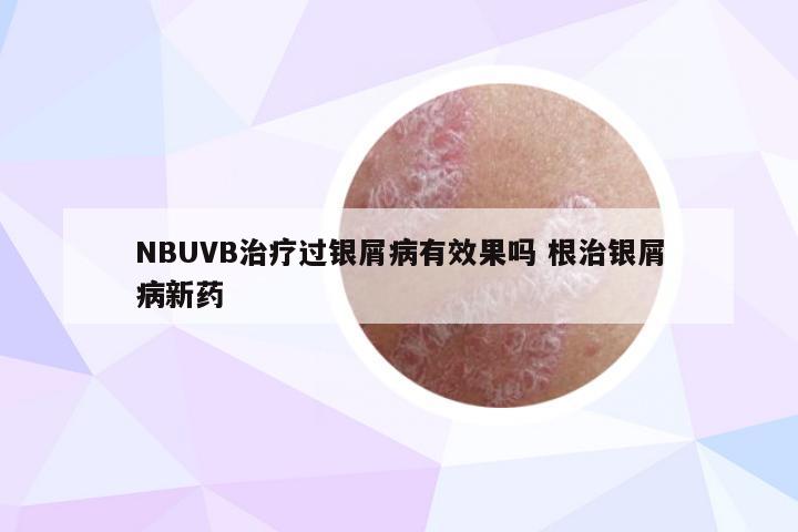 NBUVB治疗过银屑病有效果吗 根治银屑病新药