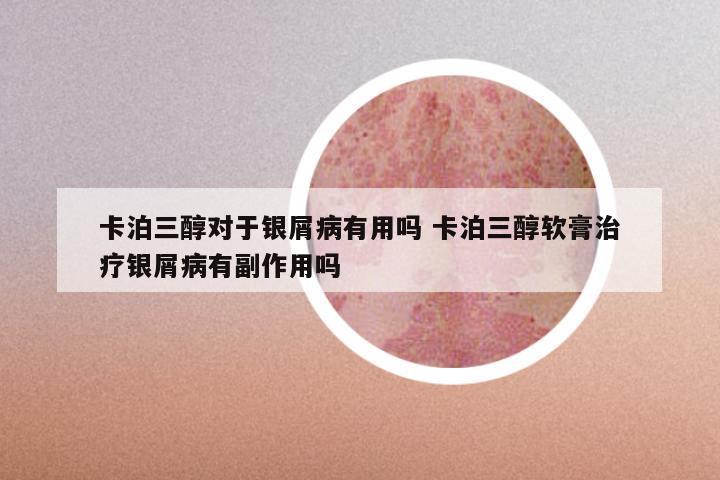 卡泊三醇对于银屑病有用吗 卡泊三醇软膏治疗银屑病有副作用吗