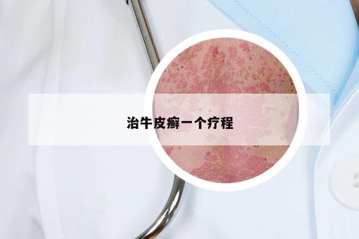 治牛皮癣一个疗程