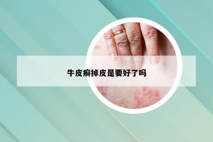 牛皮癣掉皮是要好了吗