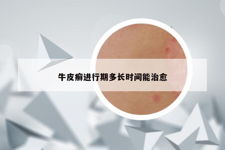 牛皮癣进行期多长时间能治愈