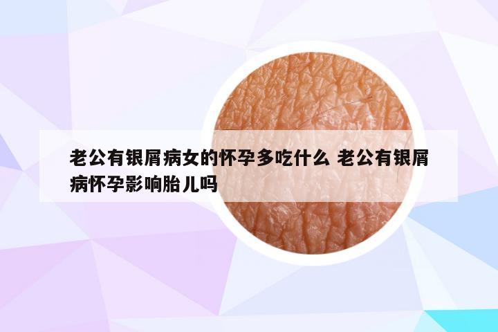 老公有银屑病女的怀孕多吃什么 老公有银屑病怀孕影响胎儿吗