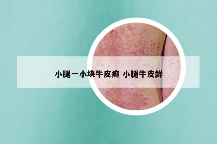 小腿一小块牛皮癣 小腿牛皮鲜