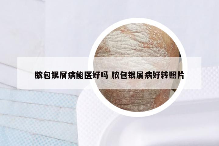 脓包银屑病能医好吗 脓包银屑病好转照片