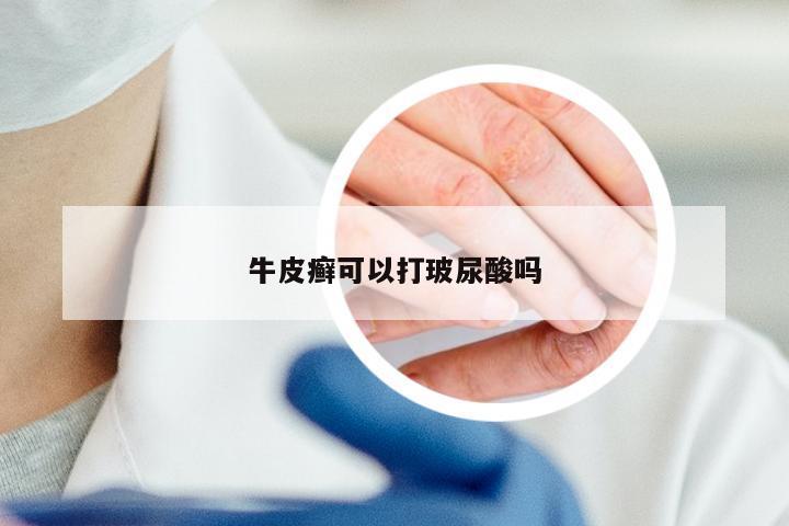 牛皮癣可以打玻尿酸吗