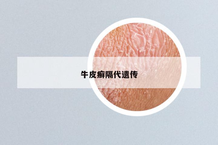 牛皮癣隔代遗传