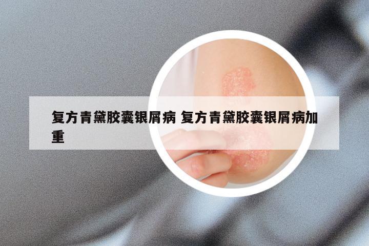 复方青黛胶囊银屑病 复方青黛胶囊银屑病加重