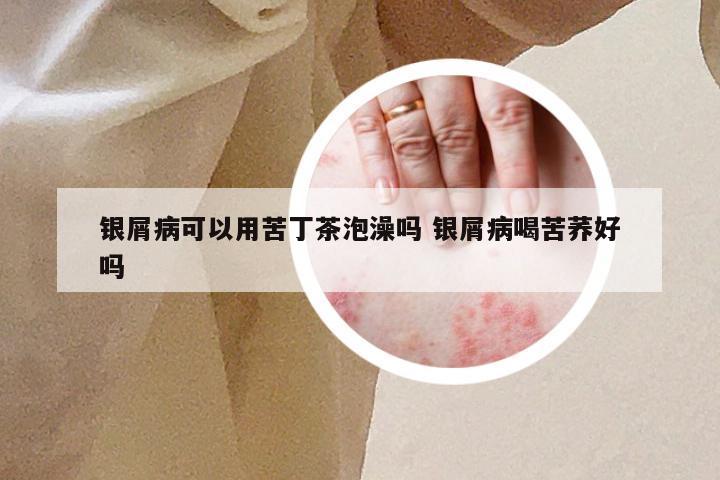 银屑病可以用苦丁茶泡澡吗 银屑病喝苦荞好吗