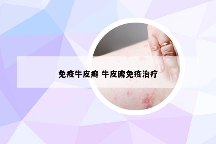 免疫牛皮癣 牛皮廨免疫治疗