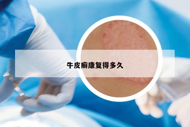 牛皮癣康复得多久