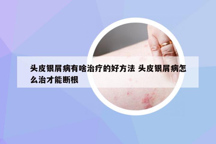 头皮银屑病有啥治疗的好方法 头皮银屑病怎么治才能断根