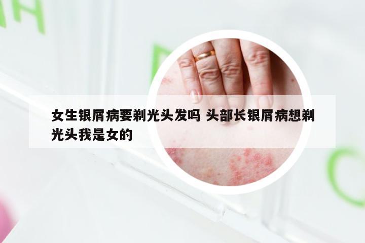 女生银屑病要剃光头发吗 头部长银屑病想剃光头我是女的