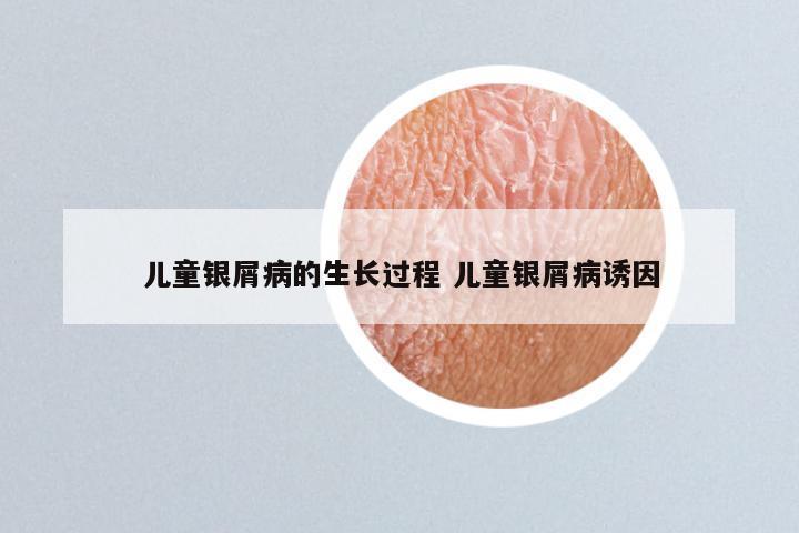 儿童银屑病的生长过程 儿童银屑病诱因
