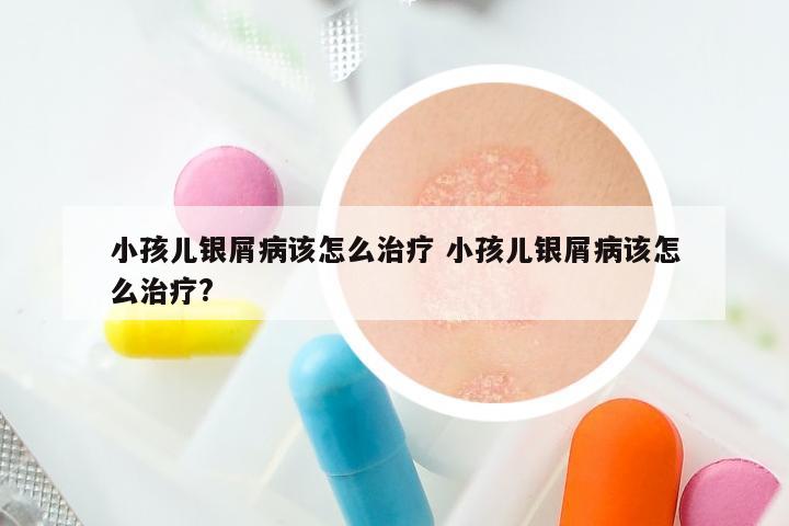 小孩儿银屑病该怎么治疗 小孩儿银屑病该怎么治疗?