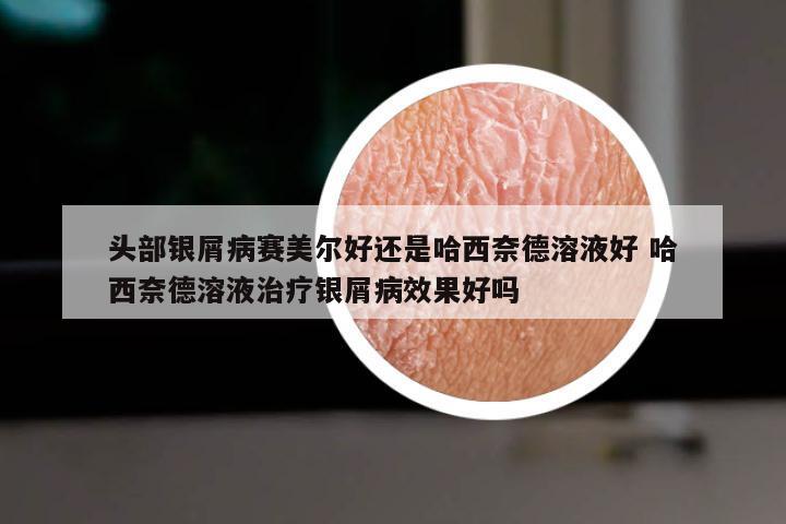 头部银屑病赛美尔好还是哈西奈德溶液好 哈西奈德溶液治疗银屑病效果好吗