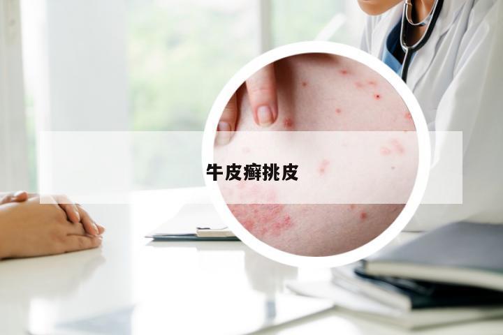 牛皮癣挑皮