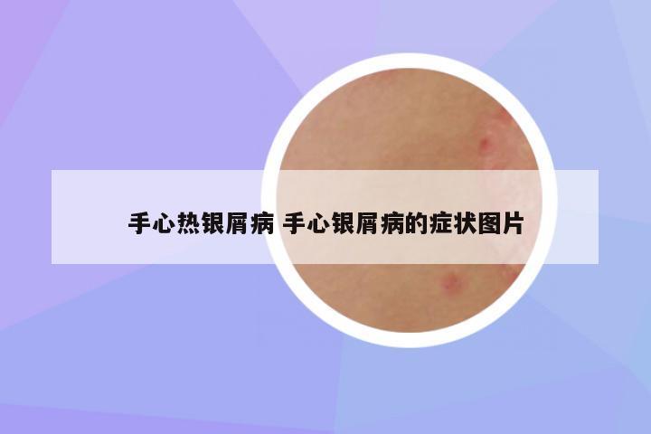 手心热银屑病 手心银屑病的症状图片