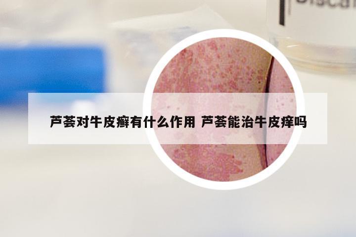 芦荟对牛皮癣有什么作用 芦荟能治牛皮痒吗