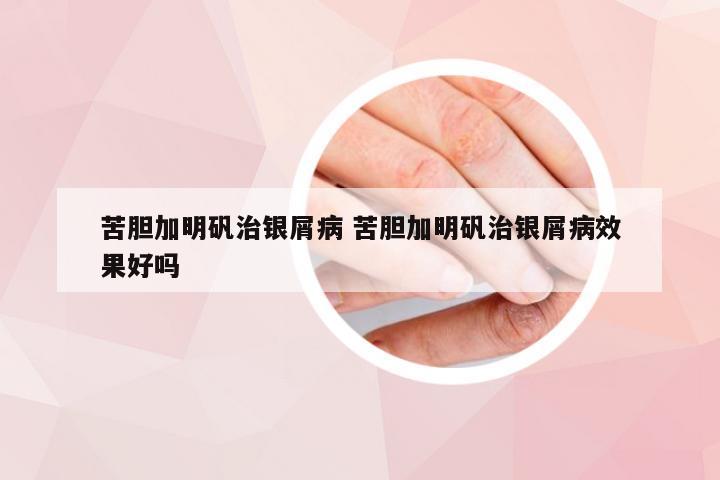 苦胆加明矾治银屑病 苦胆加明矾治银屑病效果好吗