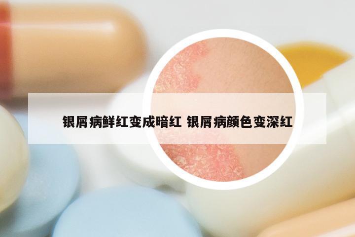 银屑病鲜红变成暗红 银屑病颜色变深红