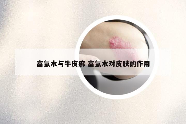 富氢水与牛皮癣 富氢水对皮肤的作用