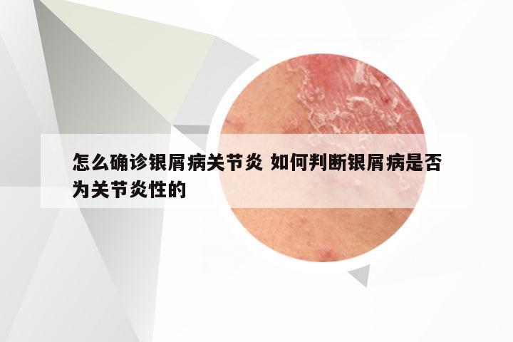 怎么确诊银屑病关节炎 如何判断银屑病是否为关节炎性的