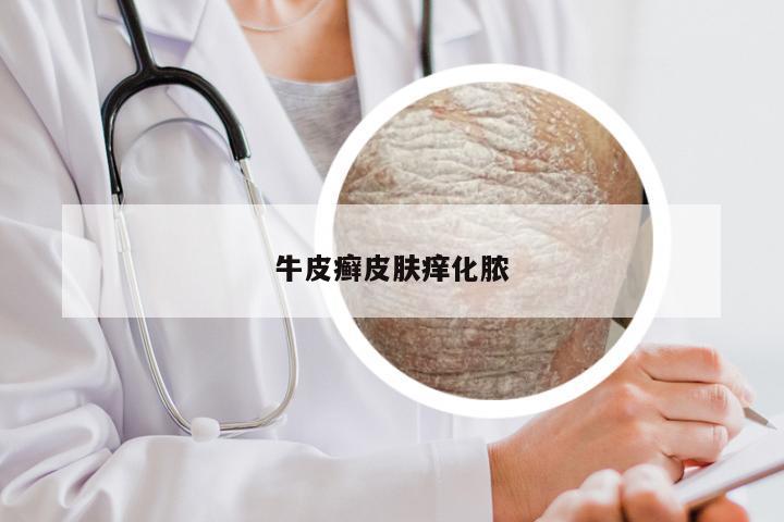 牛皮癣皮肤痒化脓