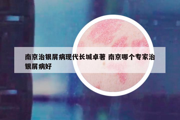 南京治银屑病现代长城卓著 南京哪个专家治银屑病好