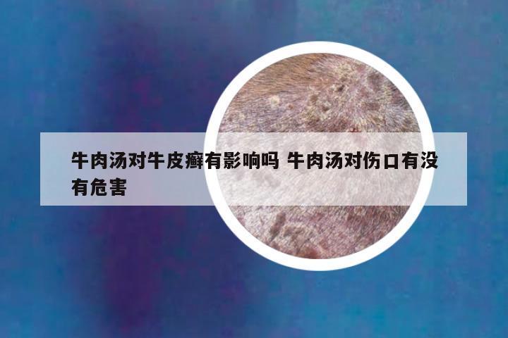牛肉汤对牛皮癣有影响吗 牛肉汤对伤口有没有危害