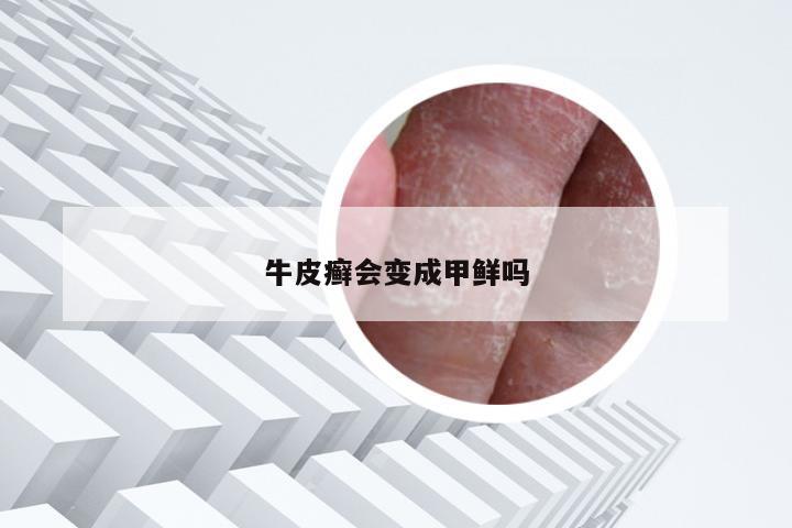 牛皮癣会变成甲鲜吗