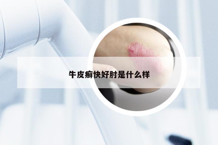 牛皮癣快好肘是什么样