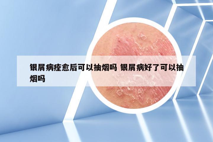 银屑病痊愈后可以抽烟吗 银屑病好了可以抽烟吗