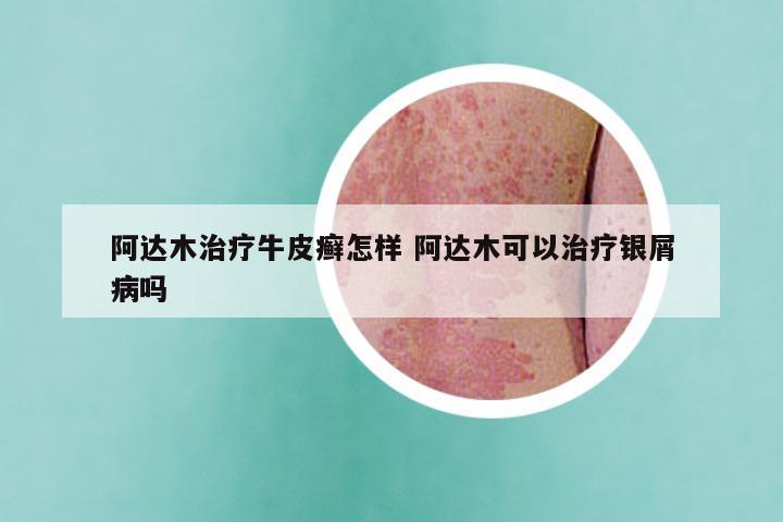 阿达木治疗牛皮癣怎样 阿达木可以治疗银屑病吗
