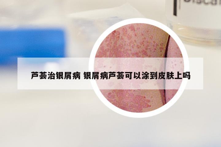 芦荟治银屑病 银屑病芦荟可以涂到皮肤上吗