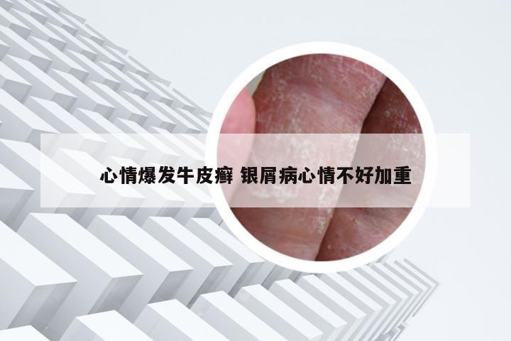 心情爆发牛皮癣 银屑病心情不好加重