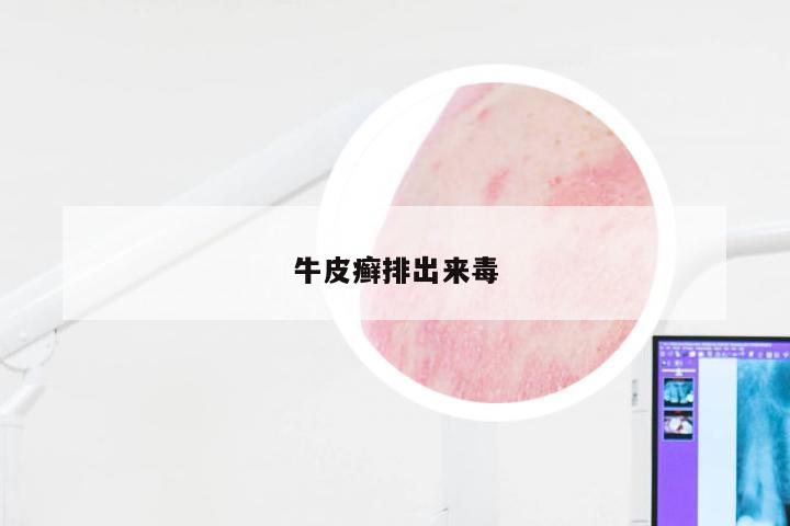 牛皮癣排出来毒