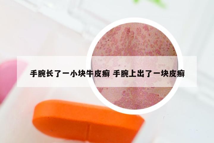 手腕长了一小块牛皮癣 手腕上出了一块皮癣