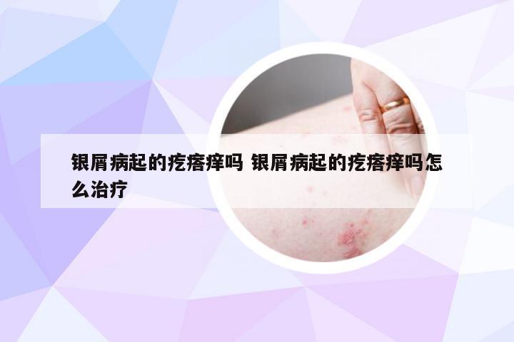 银屑病起的疙瘩痒吗 银屑病起的疙瘩痒吗怎么治疗