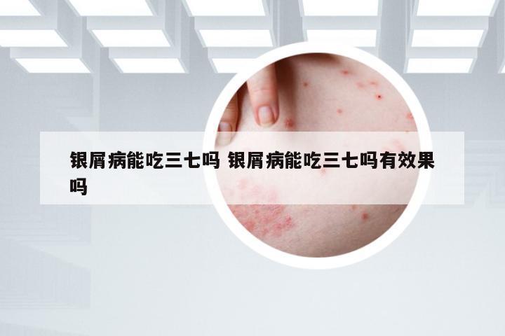 银屑病能吃三七吗 银屑病能吃三七吗有效果吗
