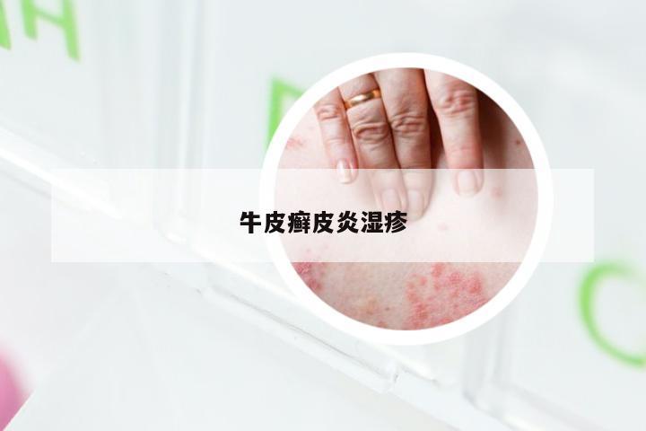 牛皮癣皮炎湿疹