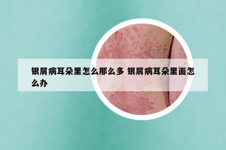 银屑病耳朵里怎么那么多 银屑病耳朵里面怎么办
