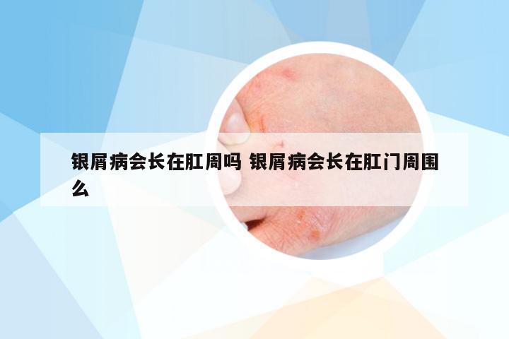 银屑病会长在肛周吗 银屑病会长在肛门周围么