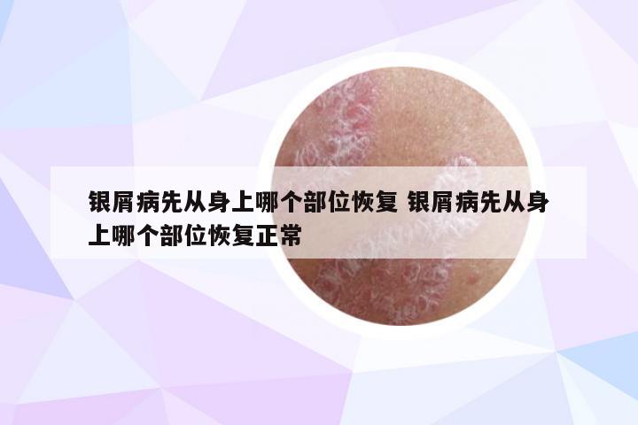 银屑病先从身上哪个部位恢复 银屑病先从身上哪个部位恢复正常