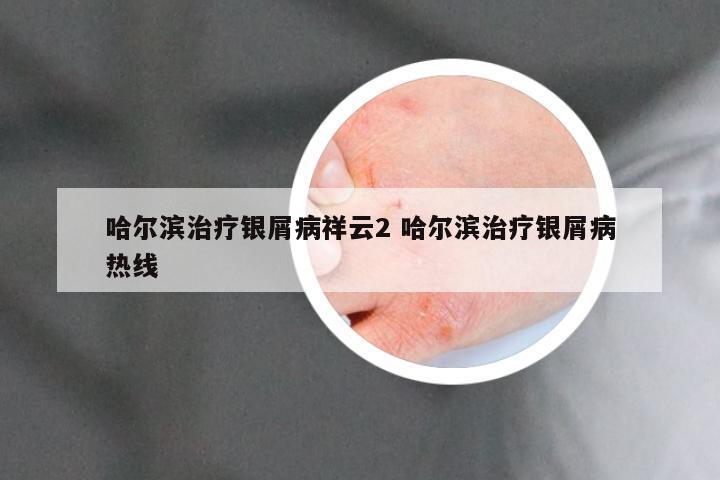 哈尔滨治疗银屑病祥云2 哈尔滨治疗银屑病热线